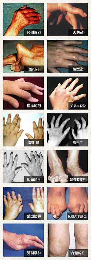 类风湿.jpg
