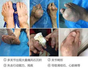 痛风导致关节畸形.jpg